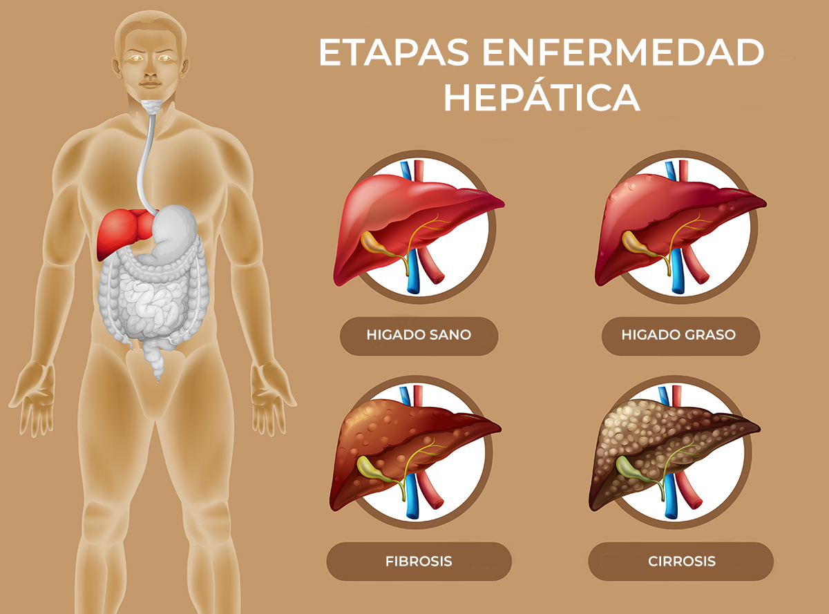 hígado graso no alcohólico