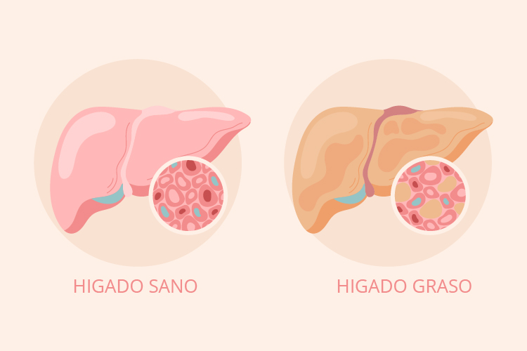 hígado graso no alcohólico